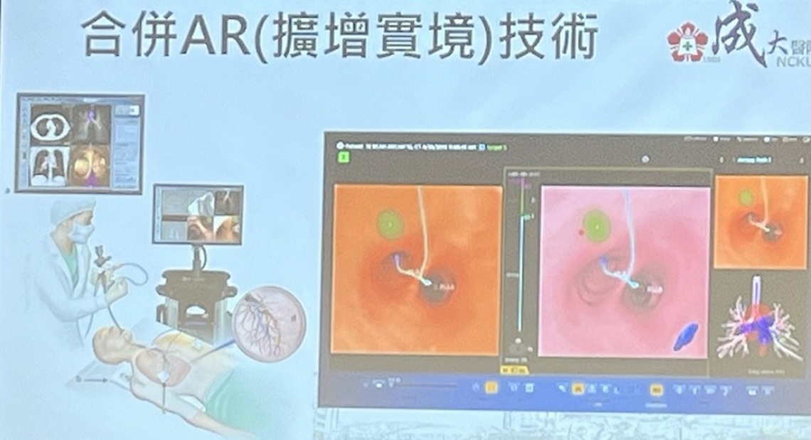 臺南成醫虛擬導航精準診斷肺癌氣管切片
