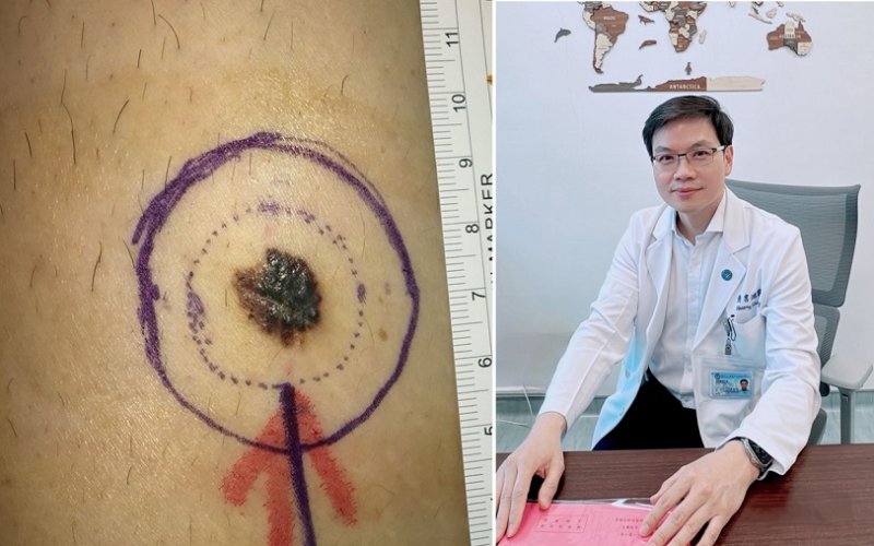 誤以為是甲溝炎竟藏「皮膚癌之冠」!高醫整外精準揪出「惡性黑色素瘤」 跨團隊守護化解致命危機 新聞圖片